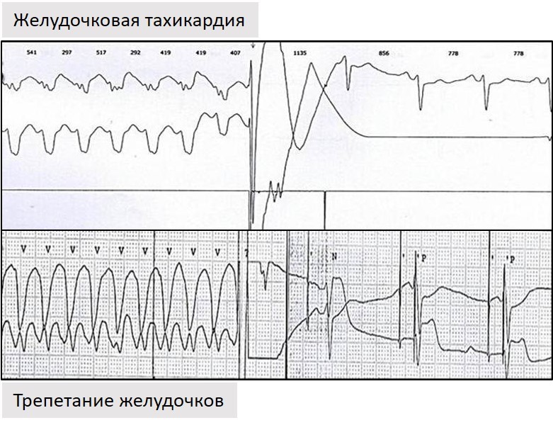 лечение желудочковой тахикардии