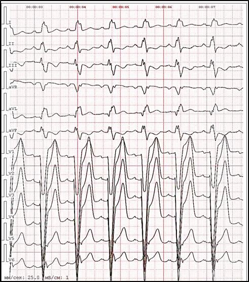 полная блокада левой ножки пучка Гиса
